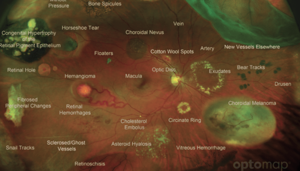 A detailed retinal image showing various eye conditions and structures like the macula, optic disc, retinal hemorrhages, and choroidal melanoma.