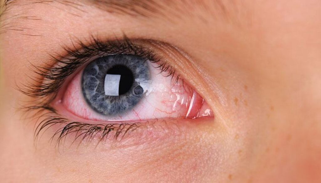 Close-up of a child's eye showing redness and irritation, possibly due to an eye infection or irritation related to COVID-19.