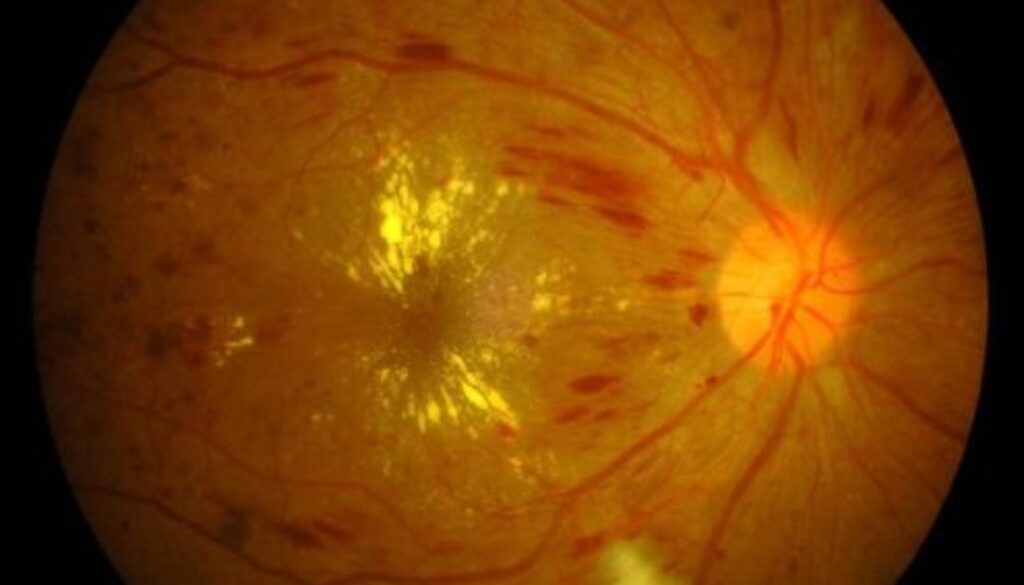 A close-up retinal scan showing potential signs of diabetic retinopathy or damage due to high blood pressure, with visible changes in the blood vessels.