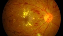 A close-up retinal scan showing potential signs of diabetic retinopathy or damage due to high blood pressure, with visible changes in the blood vessels.