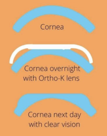 Myopia Management Myopia Management