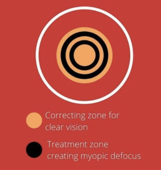 Myopia Management Myopia Management