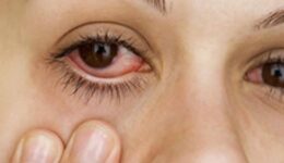 A close-up of a woman with pink eye (conjunctivitis), showing redness and irritation in the eye.