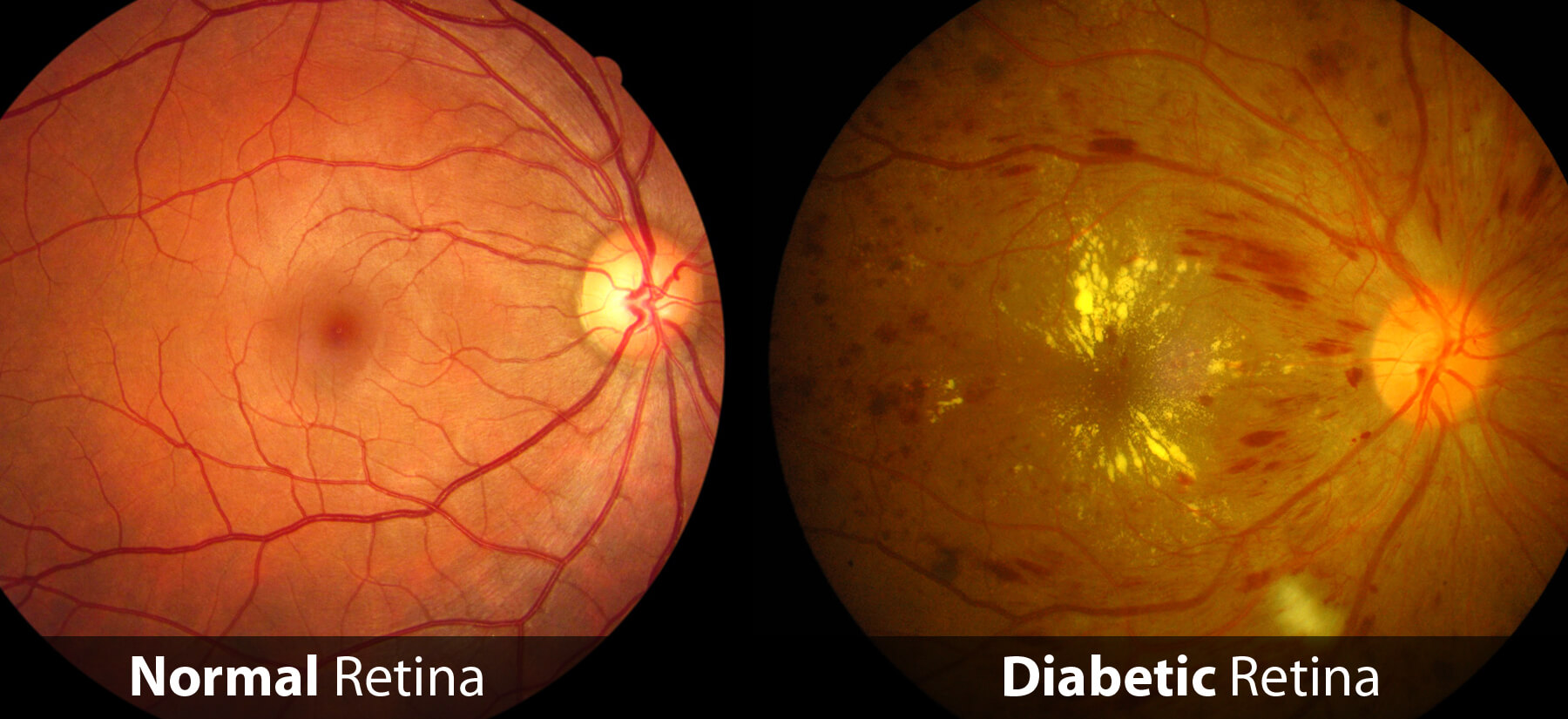Comparison of a normal retina (left) and a diabetic retina (right), showing signs of diabetic retinopathy such as bleeding and damage to the blood vessels.