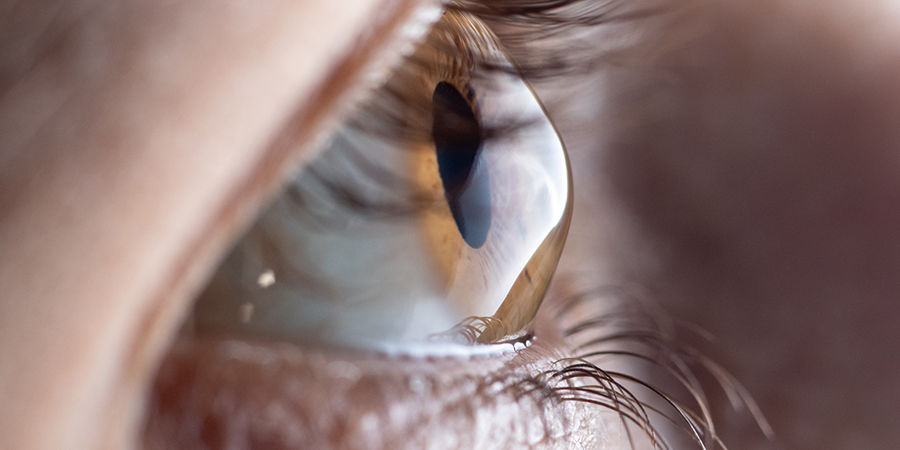 Close-up of a human eye showing the iris and cornea, with signs of keratoconus, where the cornea appears irregularly shaped.