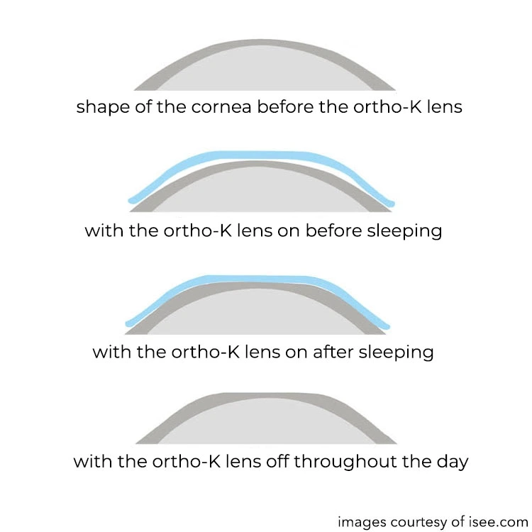 Orthokeratology Specialist Orthokeratology Specialist